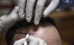 الفرق بين زراعة الشعر بدون حلاقة والطرق العادية