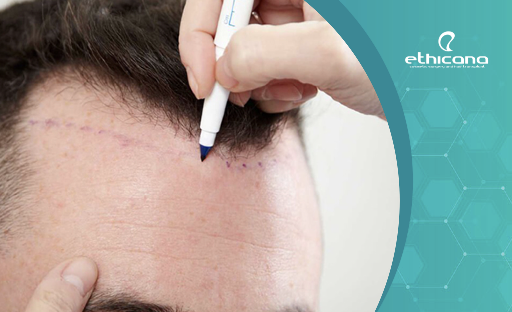 نصائح قبل إجراء عملية زراعة الشعر في تركيا