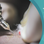تقنية الاقتطاف لزراعة الشعر