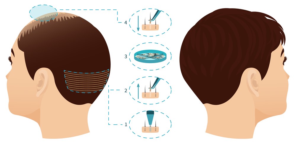 تقنيات حديثة لإجراء زراعة الشعر