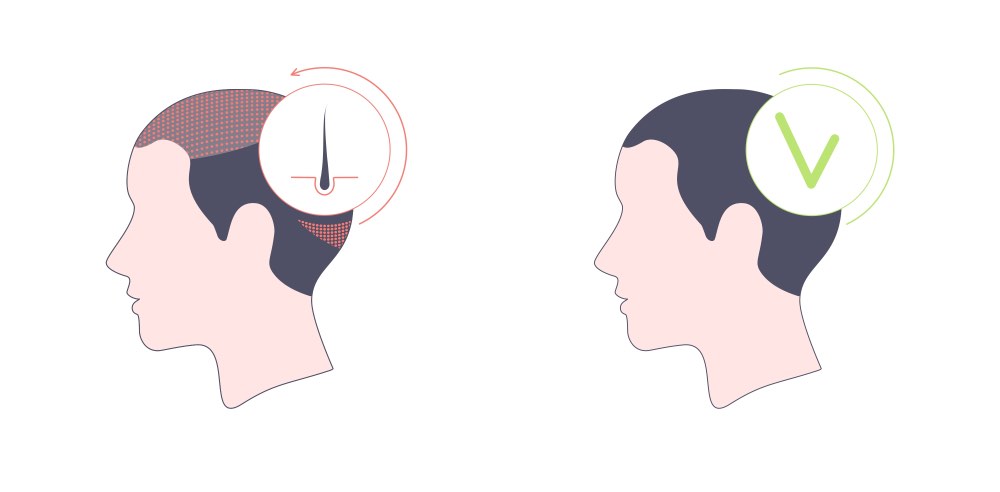 مميزات إجراء عملية زراعة الشعر في طرابزون