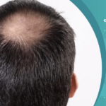 زراعة الشعر لمرضى السكر في تركيا.