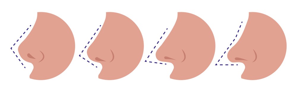 من يناسبهم إجراء عملية تجميل الأنف